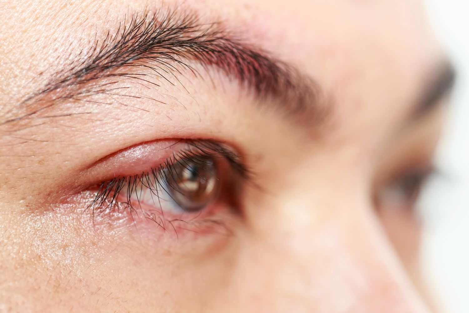 How to Get Rid of a Stye Overnight: Quick and Effective Home Remedies